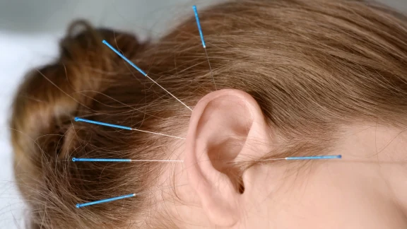 Close-up of fine acupuncture needles placed around the ear