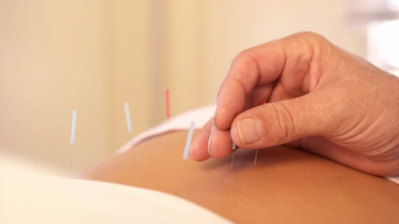 Acupuncture needle being placed in a patient's shoulder