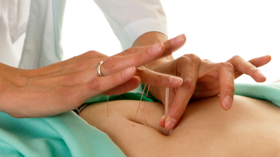 Practitioner placing fine acupuncture needles