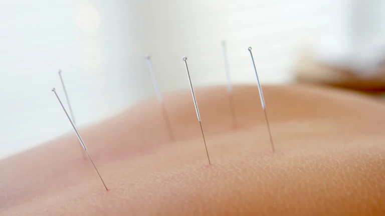 Acupuncture needles placed along the back to support energy and recovery