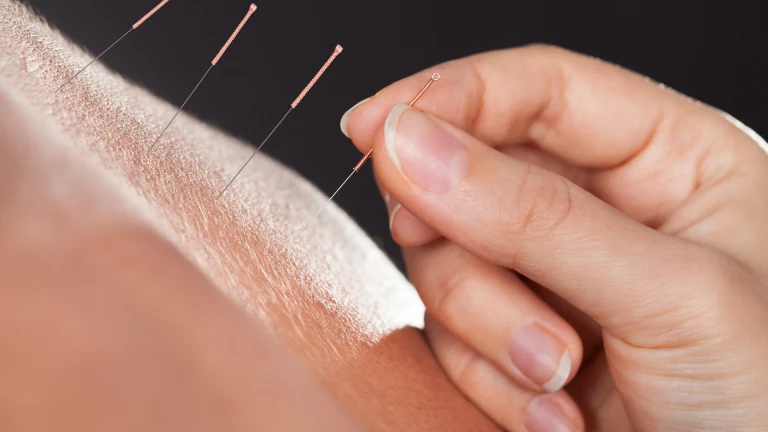 Acupuncture needles being placed to relieve stress-related tension