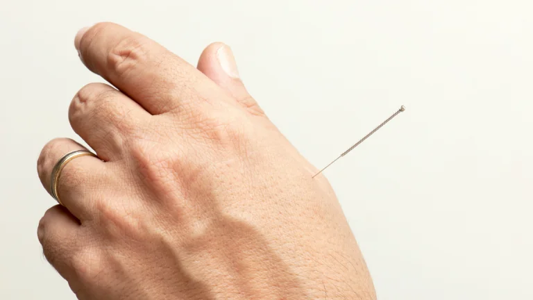 Close-up of an acupuncture needle in a patient's hand