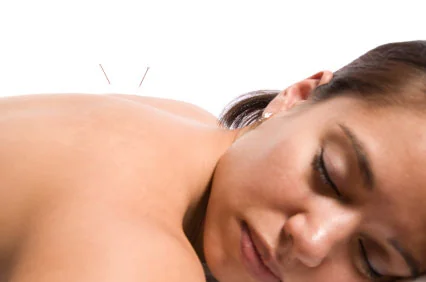 Acupuncture needles placed along a patient's upper back