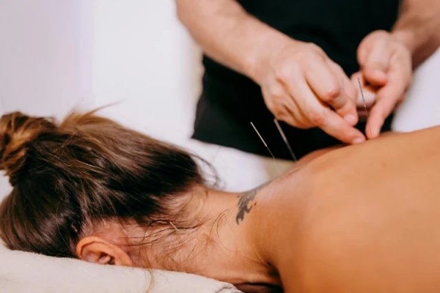 Acupuncture treatment being given at Holistic Physio, Highgate Hill